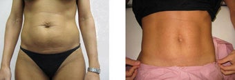 Slim Lipo laser liposuction and mini tummy tuck before 64348