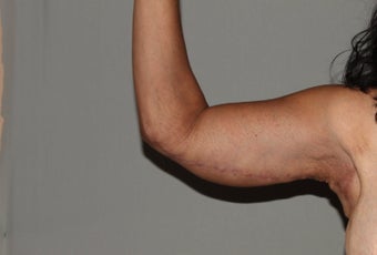 Arm Lift-Brachioplasty after 607363
