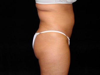 Liposuction of Abdomen, Waist, Flanks, and Inner/Outer Thighs before 203476
