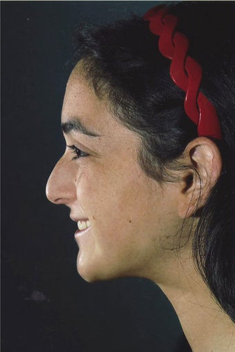 Rhinoplasty 327037