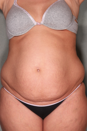 SmartLipo™ before 529476