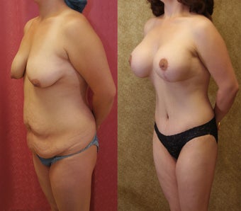 Tummy tuck with breast lift 587843