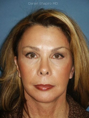 Chin augmentation with facial rejuvenation after 250149