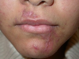 Scar Treatment 555507