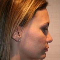 Revision Rhinoplasty after 443004
