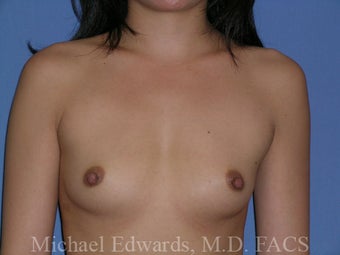 Breast Augmentation before 88117