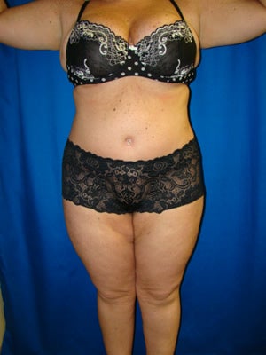 Extended Tummy Tuck, Back Lipectomy after 139078