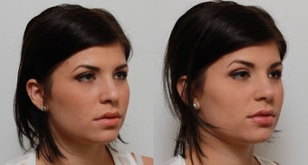 Non Surgical Nose Job Rhinoplasty after 553496