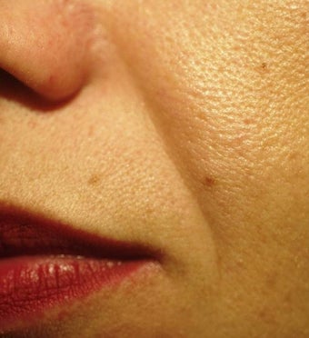 Sculptra before 197939