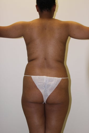 Brazilian Butt Lift before 598213