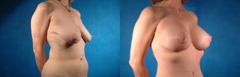 Breast Lift and Augmentation before 101817