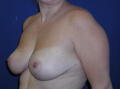Reduction Mammaplasty after 141194