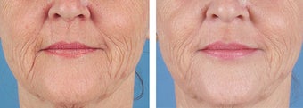 Dermal Filler to Wrinkles before 253626