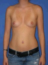 Breast Augmentation Surgery before 155736