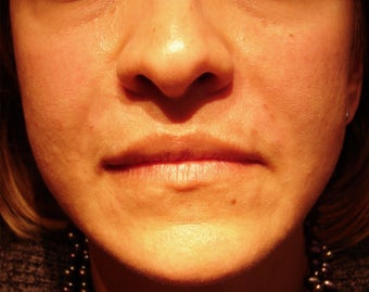 Nasolabial Fold Treatment after 271684