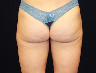 Liposuction of Saddlebags 494851