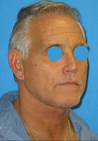 Limited incision neck lift after 84225