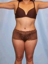 Tummy Tuck Surgery (abdominoplasty) after 139139