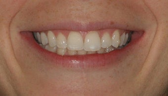 Invisalign after 213060