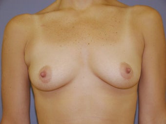 Breast Augmentation before 512176