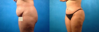 Tummy Tuck and Liposuction before 134130