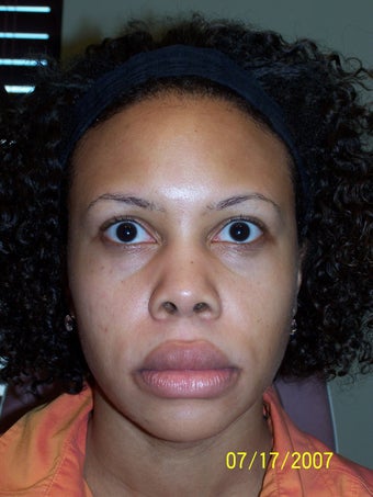 Rhinoplasty before 368023