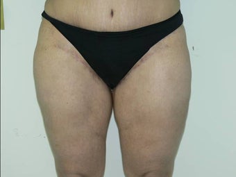 Inner thigh lift after 234247