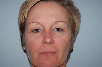 IPL Limelight Laser treatment, Pearl Laser Treatment and Botox after 429560