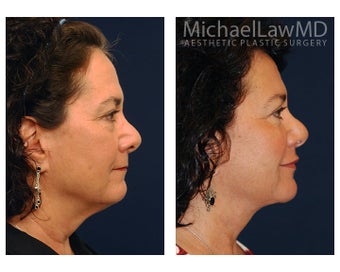 Facial Rejuvenation - Lower Face Lift 395206