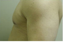 Male Breast Reduction 141526