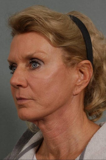FaceLift after 269514