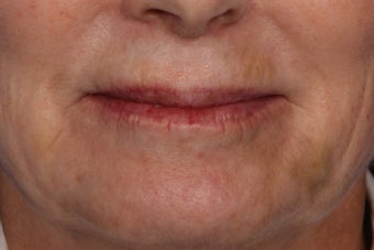Botox and Juvederm after 309243