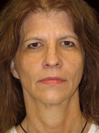 Face lift,brow lift, eyelid lift before 250983