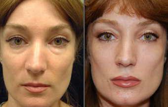 Liquid Face Lift with Silikon-1000 before 95863
