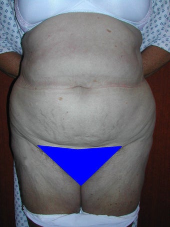Extended Tummy Tuck before 119745