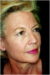 Facelift, Endoscopic Forehead Lift, Quadrilateral Blepharoplasty before 205363