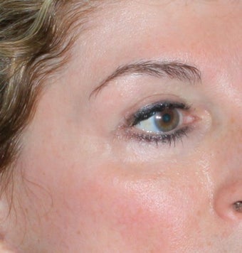 Laser vein removal after 374354
