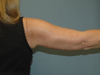 Liposuction after 581446