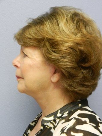 Lower Face with Neck Lift 598901