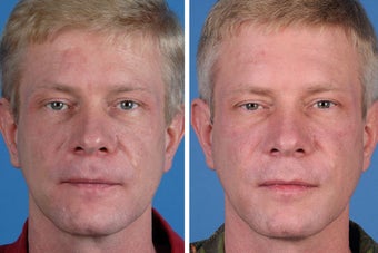 Radiesse, Restylane, Juvederm Plus & Botox Cosmetic before 356492