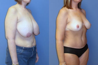 breast reduction and abdominoplasty after 579282