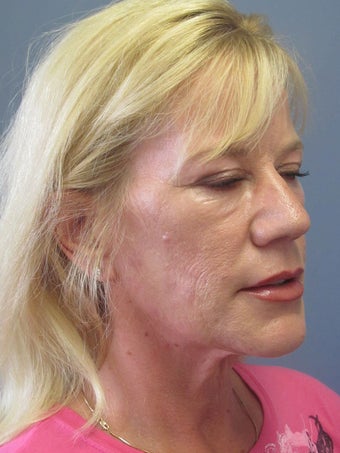 Neck Lift, Platysmaplasty 634737