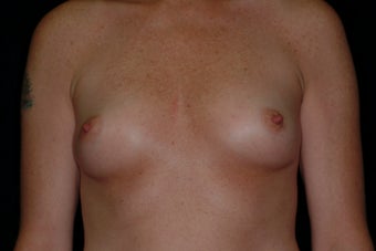 Breast Augmentation before 336384