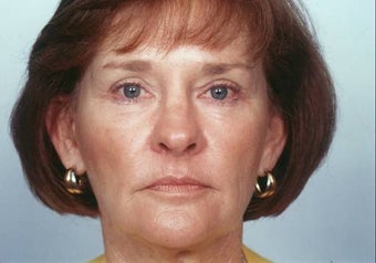 Laser Skin Resurfacing after 337221