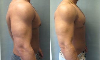 Gynecomastia Surgery after 341129