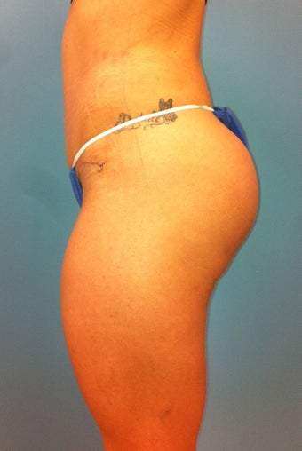 Gluteal Implants after 539055