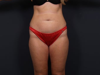 Tummy Tuck before 462576