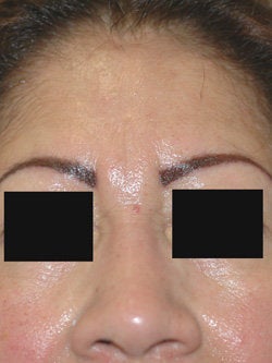 Botox for frown line (glabella) after 91302