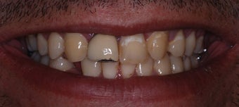 Veneers and Crowns before 141910