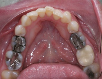 Mercury Silver filling replacment before 372796